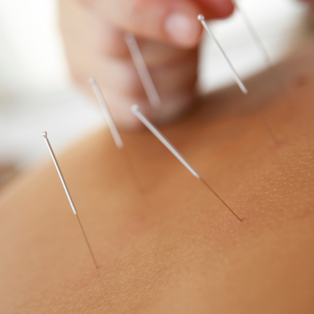 acupuntura